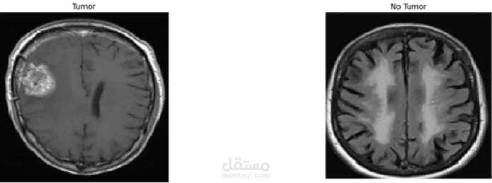 تصنيف أشعة الدماغ والثدي و تحديد مكان الورم (Segmentation) | مستقل