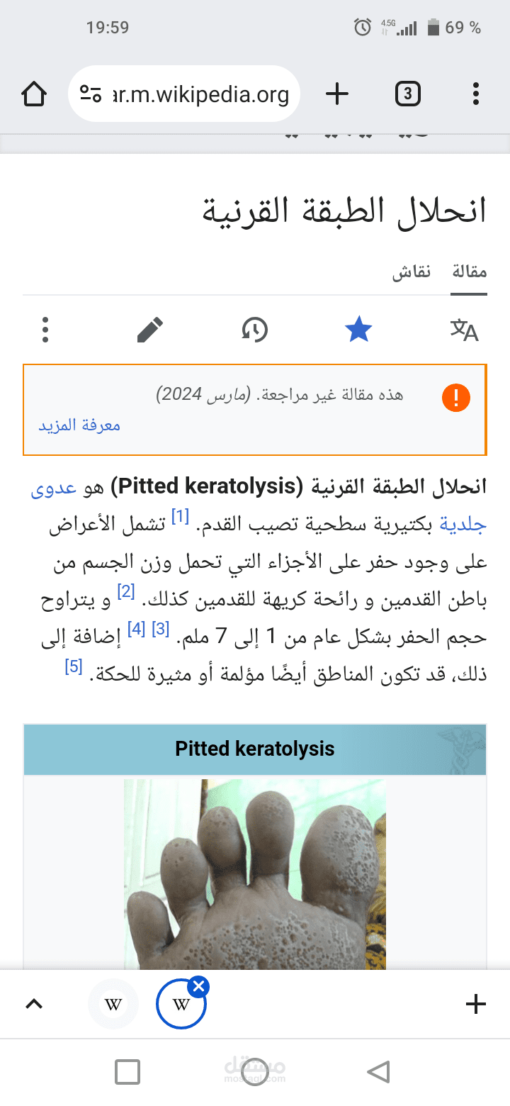 انحلال الطبقة القرنية