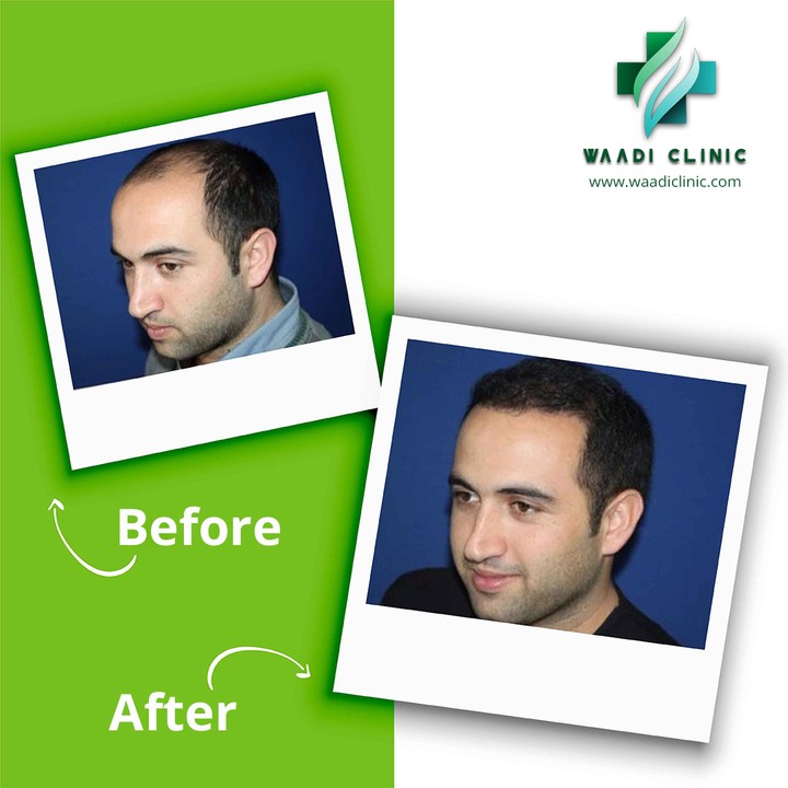 Waadi Hair Transplant