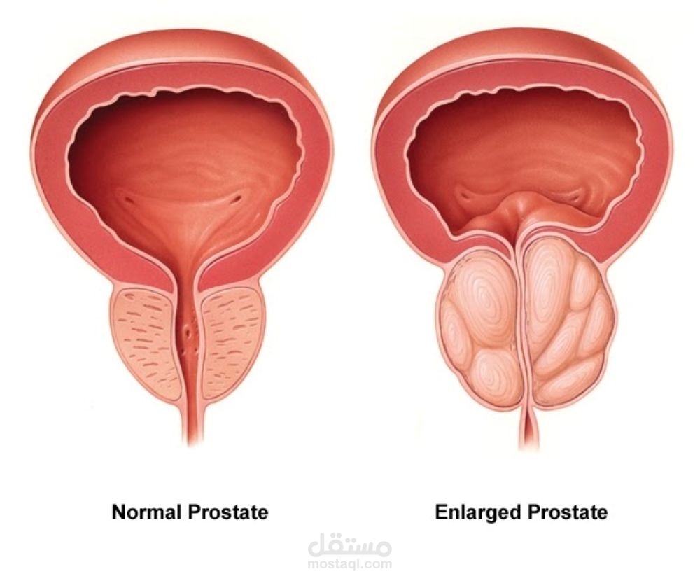 احتقان البروستاتا (Prostatits) | هل يسبب سرطان البروستاتا؟