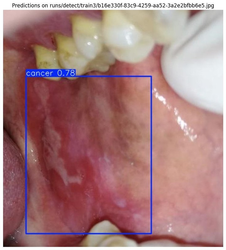 Oral Cancer Detection