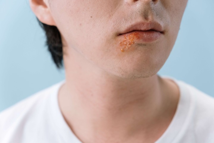 Natural remedies for canker sores