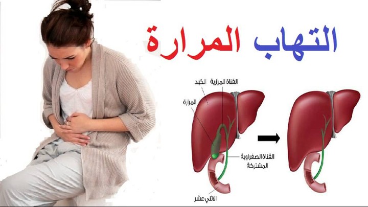 ترجمة مقال بعنوان التهاب المرارة