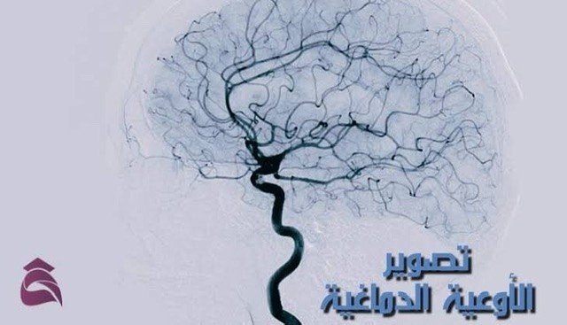 تصوير الأوعية الدماغية تعرف على هذا الفحص بالتفصيل  Cerebral Angiogram