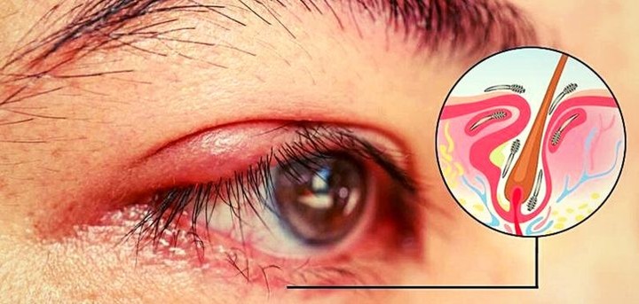 العد الوردي العيني (Ocular rosacea)