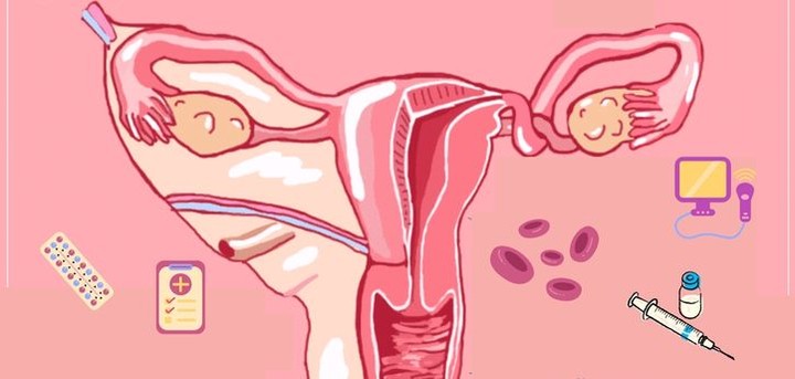 التواء المبيض (Ovarian Torsion )