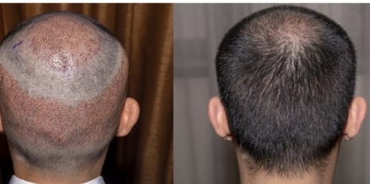 تكلفة زراعة الشعر في الرياض