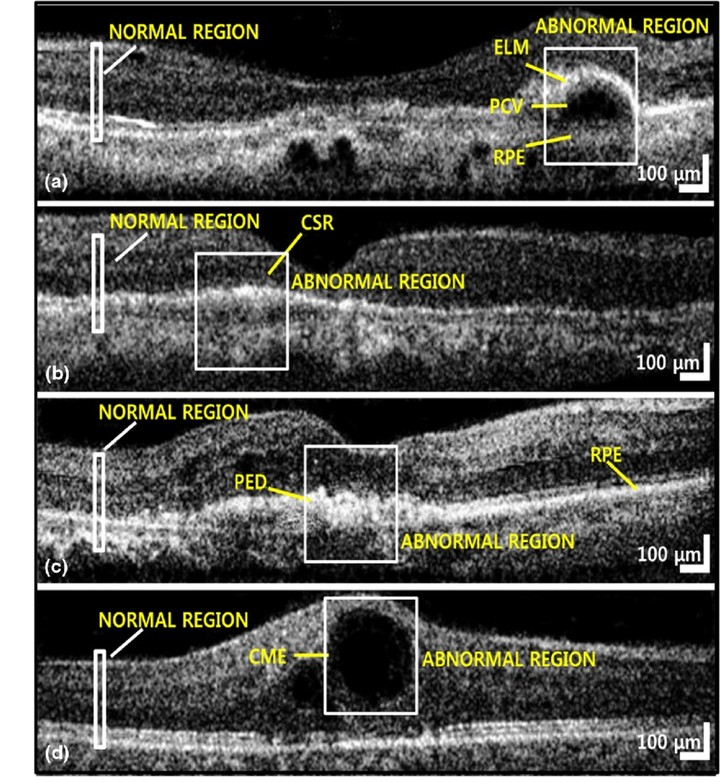 Retinal disorder's detector