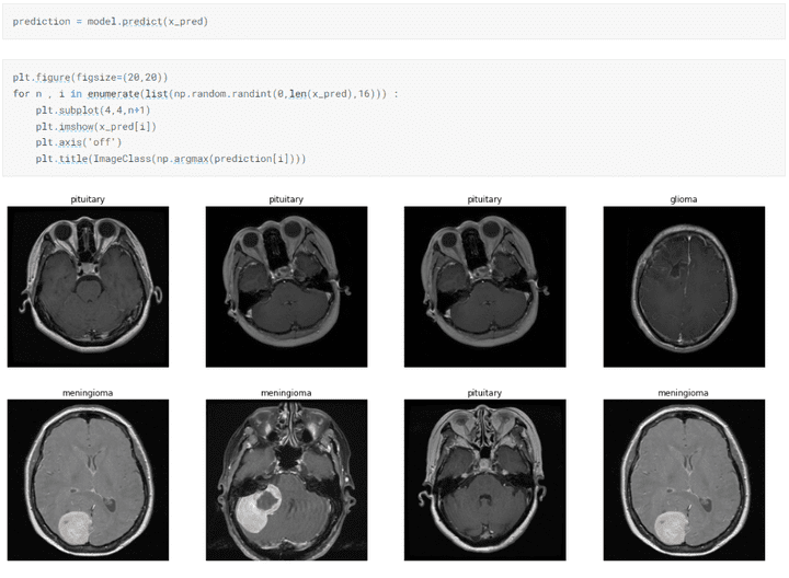 brain_tumor classification