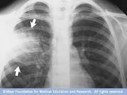 ترجمة موضوع للالتهاب الرئوي Pneumonia من اللغة الإنجليزية للغة العربية