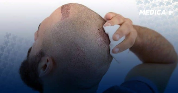 مقالة مخاطر زراعة الشعر على موقع ميديكا بلس