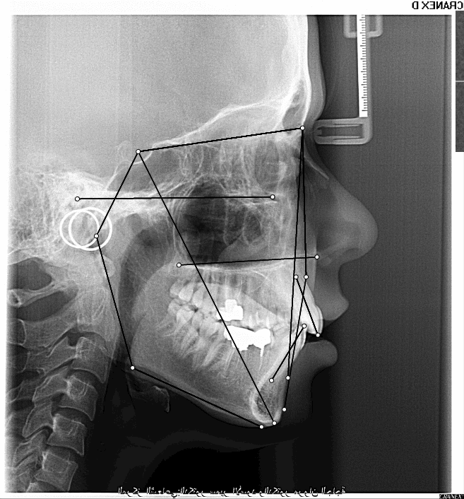WebCeph - تطبيق ترسيم الصور الشعاعية لأطباء تقويم الأسنان