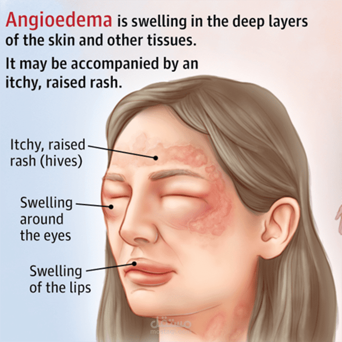 Evidence Based Management Of Ace Inhibitors Induced Severe Angioedema مستقل 6331