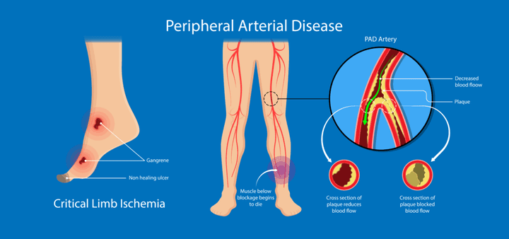 limb ischemia