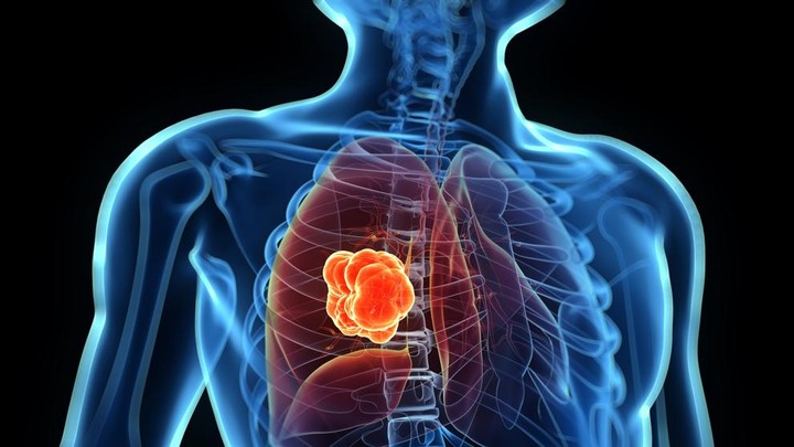 بحث عن سرطان الرئة "طرق التشخيص و النتائج المتوقعة"