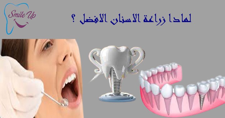 تصميم لمشروع زراعة أسنان