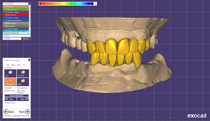 Zirconia upper & lower