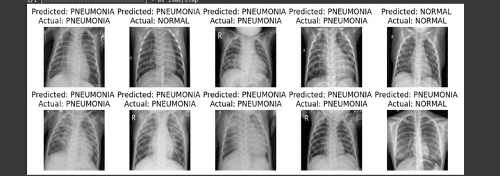 AI-PneumoScan: Intelligent Chest X-ray Classifier