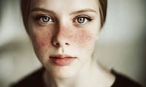 Scientific research : Systemic lupus erythematosus