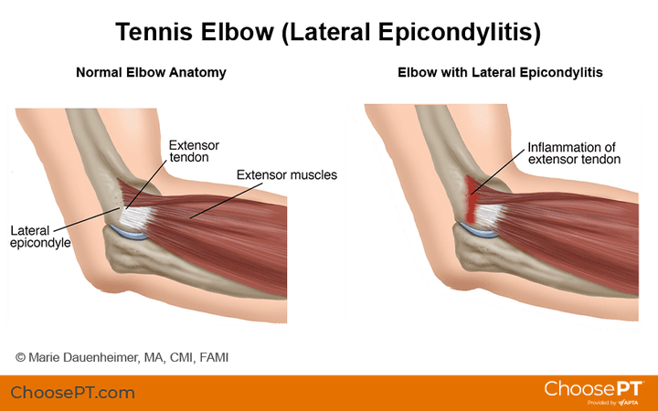 Clinical Research about Physical therapy interventions verus Injection therapies in the treatment of Lateral Epicondalitis