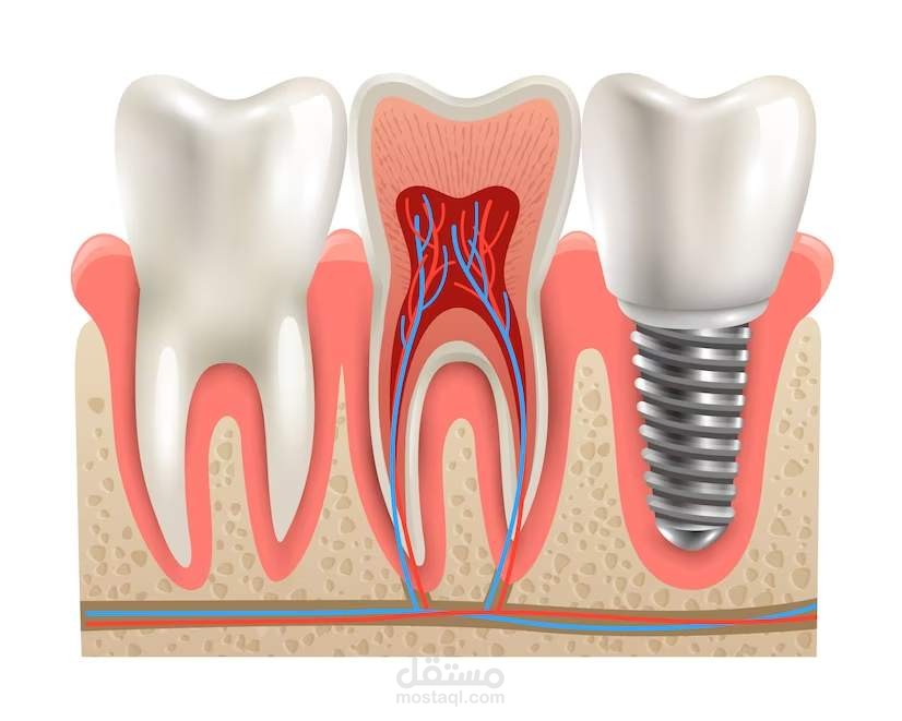 أفضل أنواع زراعة الأسنان عالمياً | اختر ما يُناسبك
