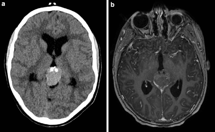 Brain Cancer Prediction