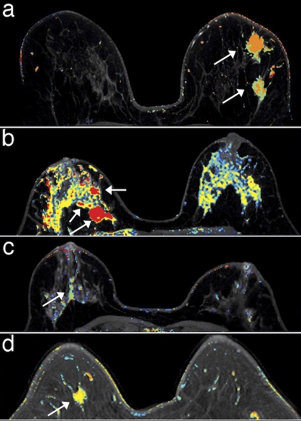 Breast Cancer Prediction