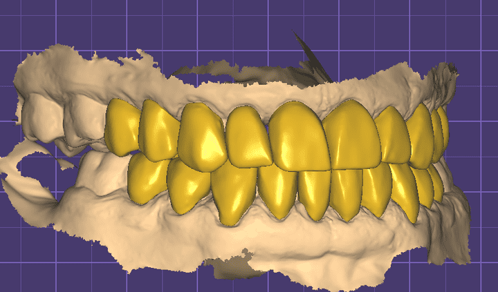 تصميم على برامج Exocad