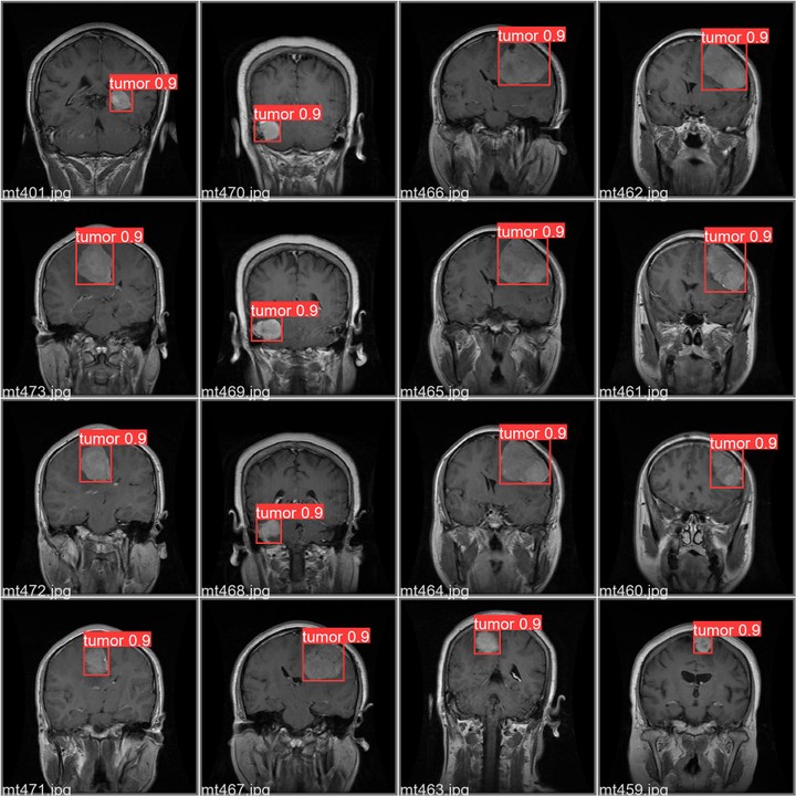 Brain Tumor Detection