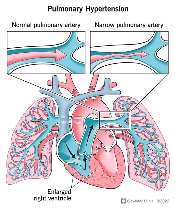 Cirrhosis and Portal Hypertension