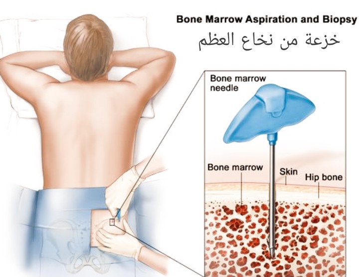 Bone marrow aspiration خزعة من نخاع العظم