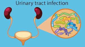 إعداد القسم النظري لأطروحة ماجستير بعنوان Treatment  Options  for  Uncomplicated  Urinary  Tract  Infections  Caused  by  Extended-Spectrum-β-Lactamase-Producing  Escherichia  coli