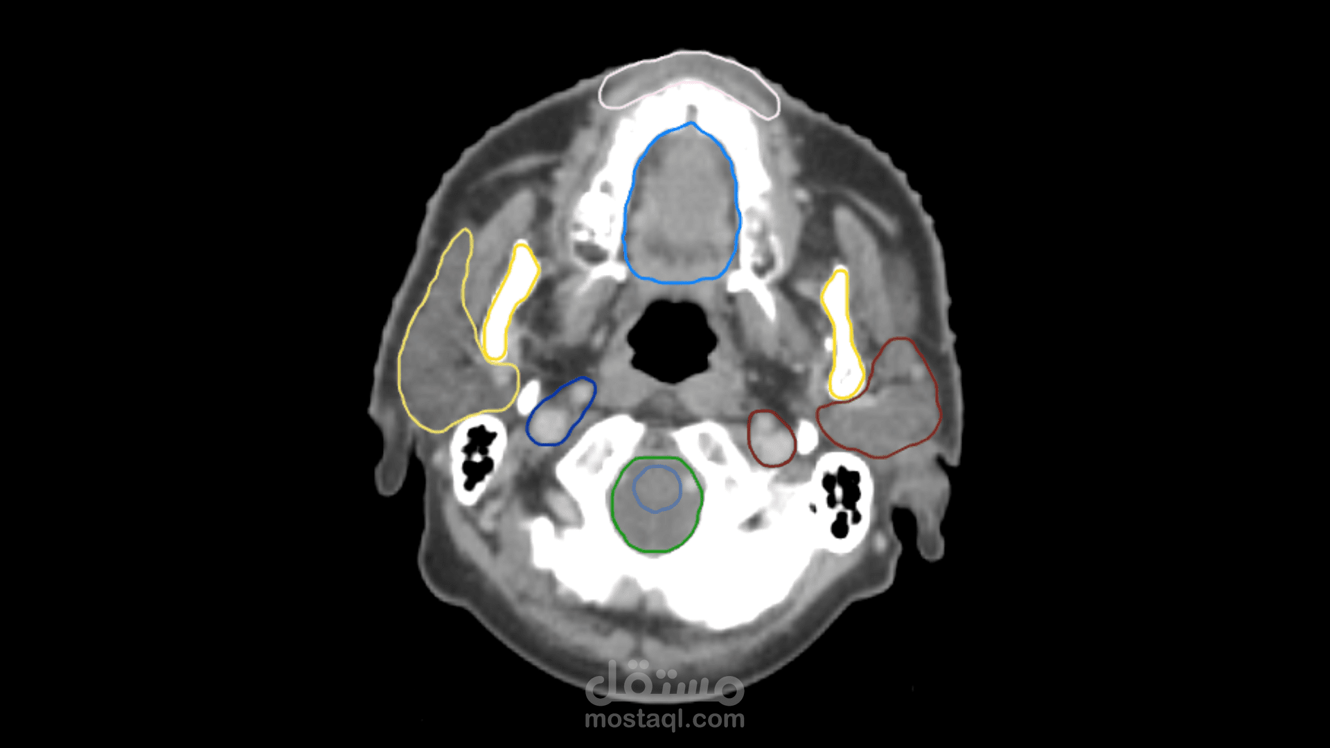 AI-Powered Enhancement of CBCT for Brain Adaptive Radiotherapy