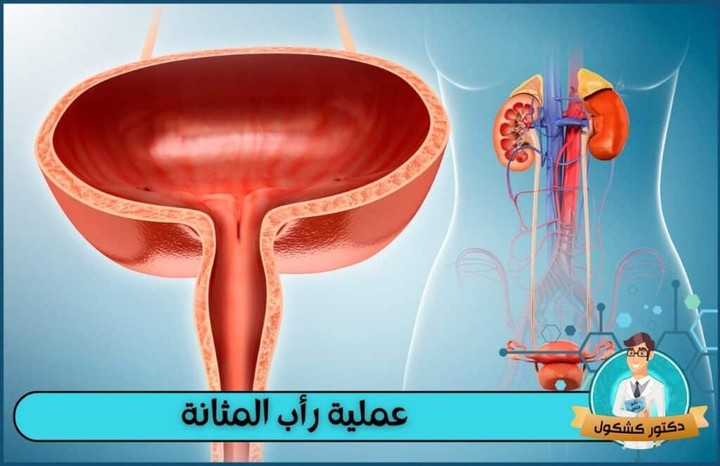 عملية رأب المثانة | تعريفها وآليتها ومضاعفاتها