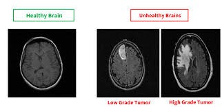 Brain Tumor Classification Using Deep Learning