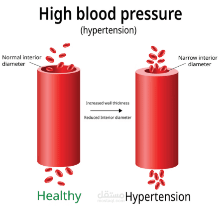 Hypertension (Medical Report)