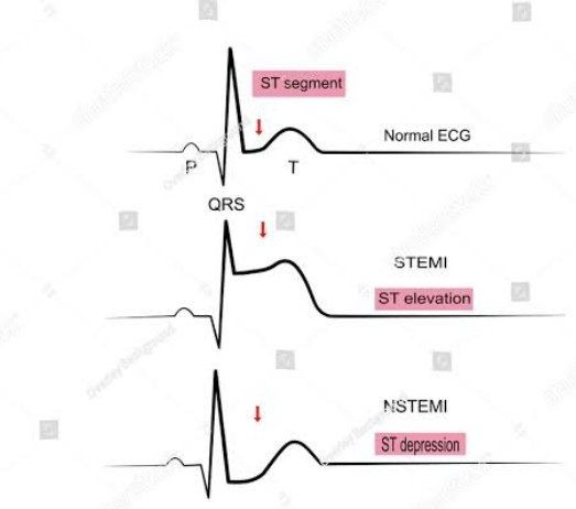 Acute coronary syndrome ACS