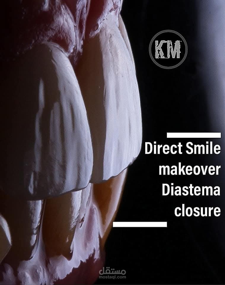 Dental Video editing of diastema closure