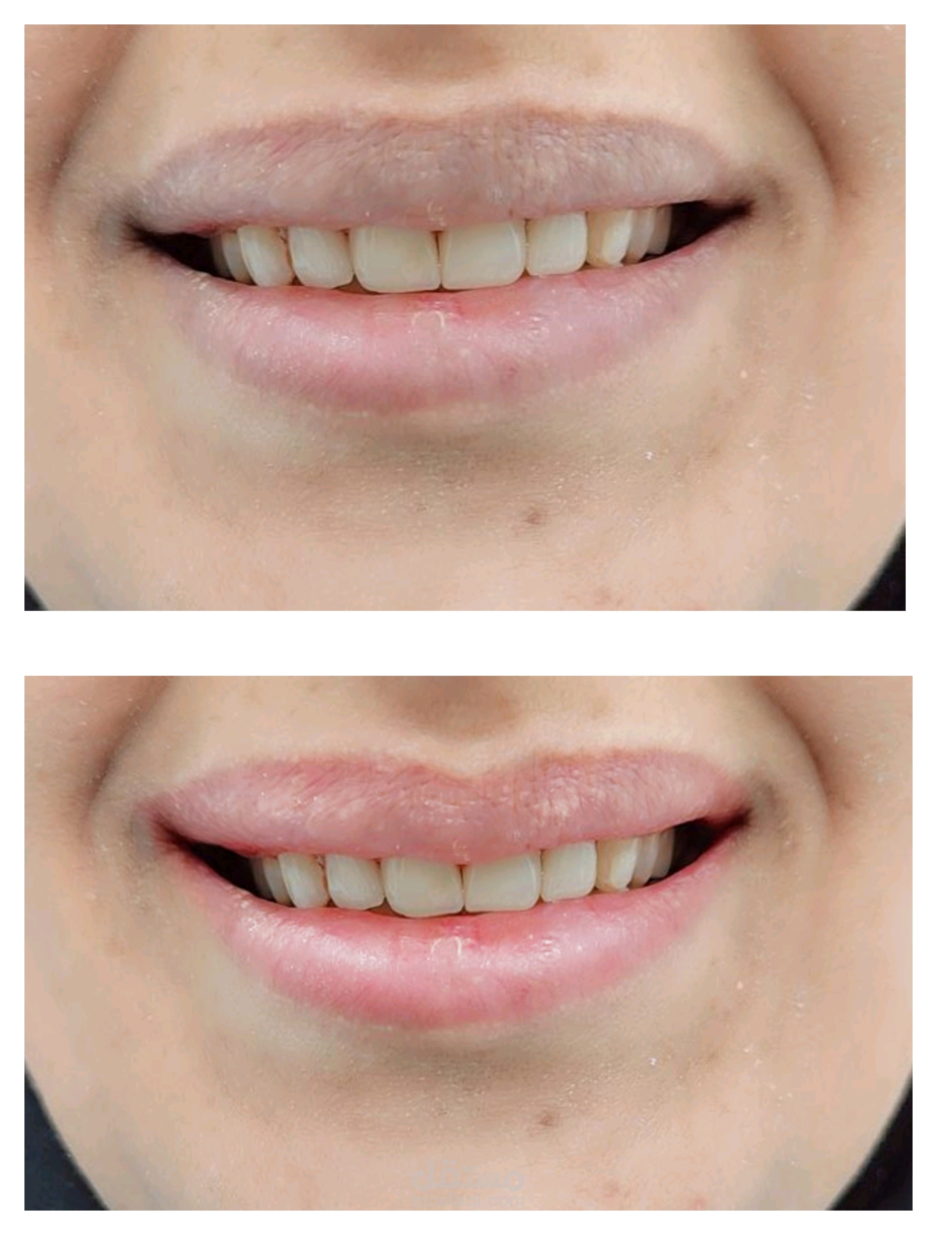 تعديل الصور (Before & After)