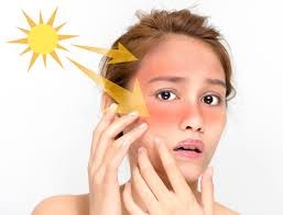 Home Remedies for Sunburn