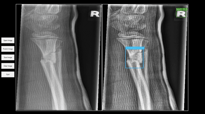 Bone Fracture Detection