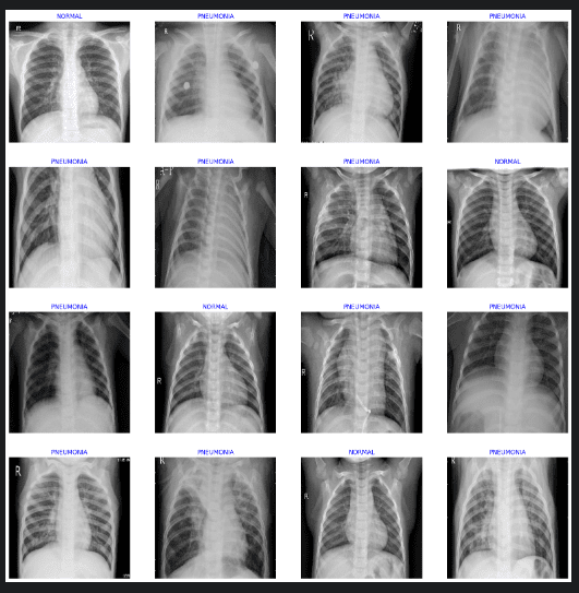 Pneumonia Detection by fine tuning pre-trained model