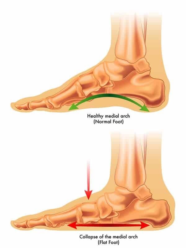 flat foot gait cycle