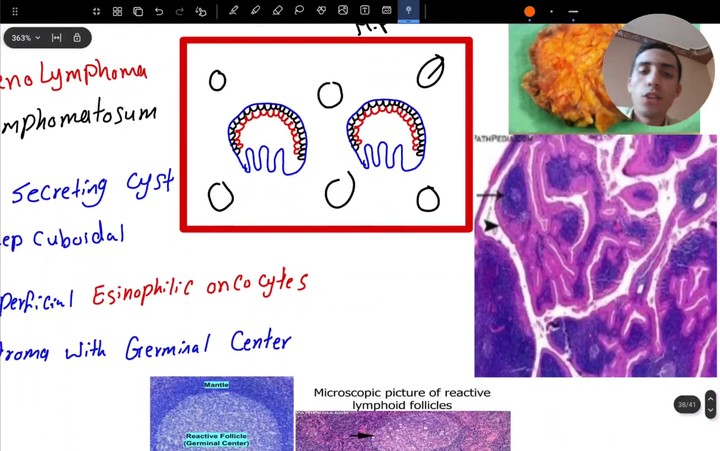 شرح ال Salivary gland pathology