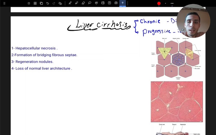 محاضرة ال Liver cirrhosis تليف الكبد