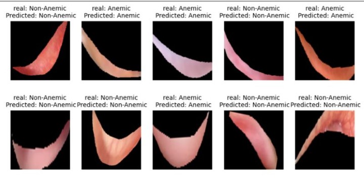 بناء مودل تعلم عميق Anemia Detection