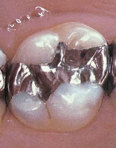 كتابة محتوى طبي في مجال طب الاسنان : عن Amalgam Restorations