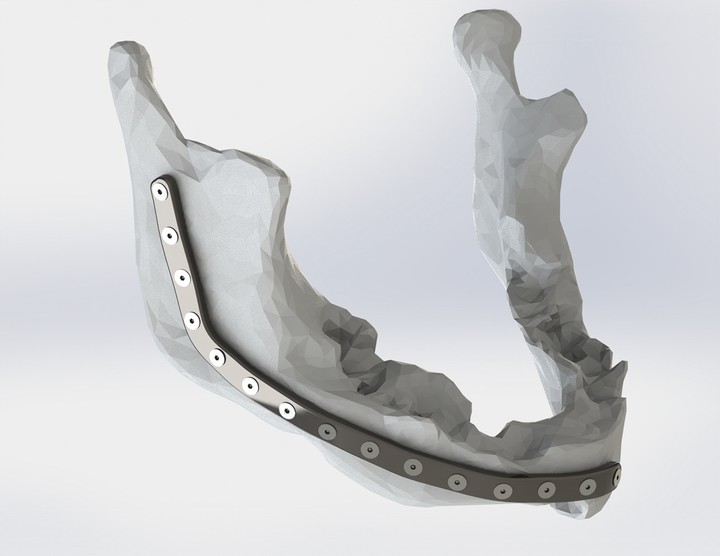 Free surface design for Mandible reconstruction implant