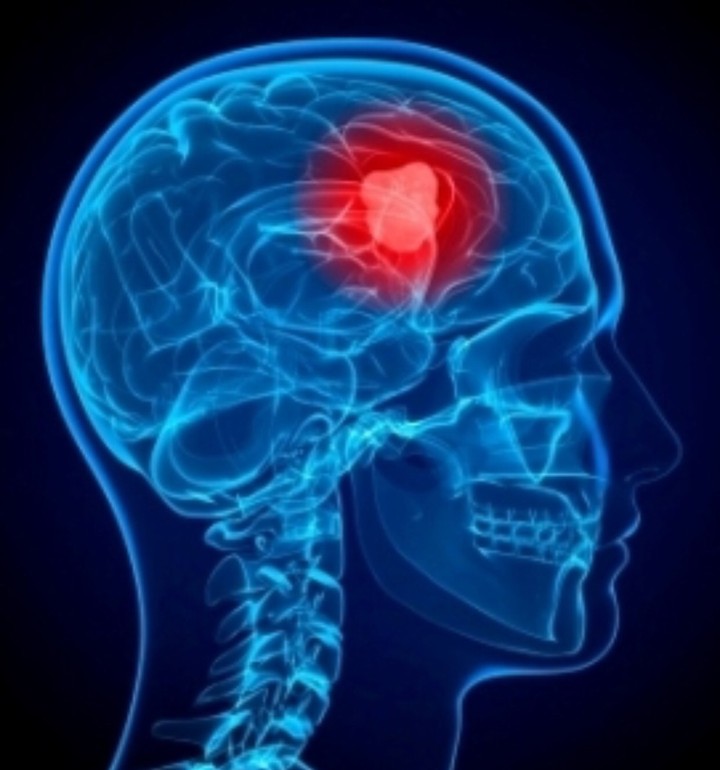 نظام ذكي لكشف أورام الدماغ باستخدام صور MRI