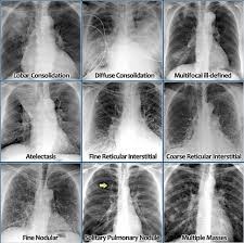 Chest X-Ray by ai